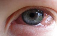 آلرژی های چشمی