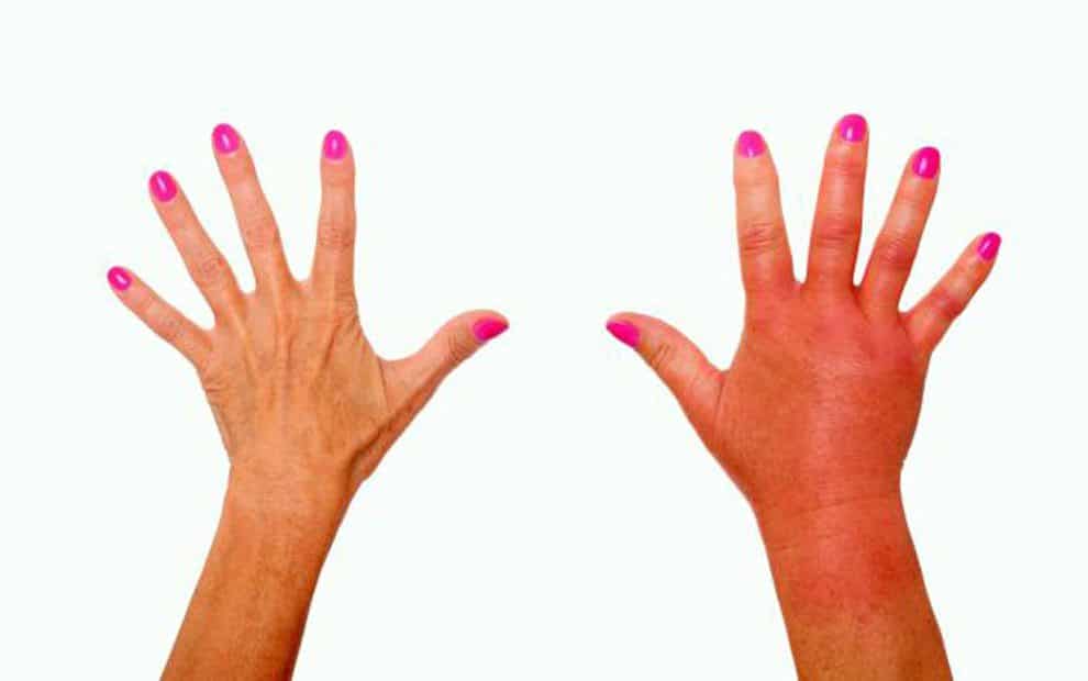 علت ورم کردن دست پس از ورزش