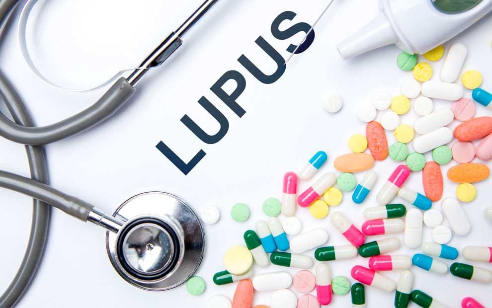 بیماری لوپوس سیستمیک